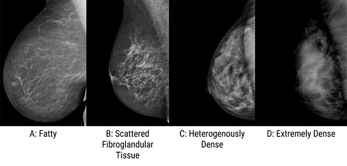 Radiation Dose In Mammography Article Medical Professionals