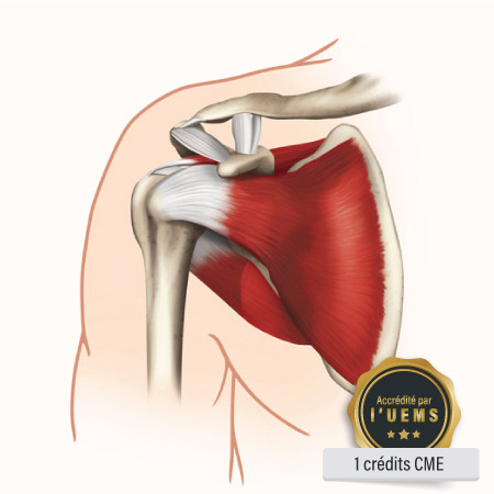 Lésions de la Coiffe des Rotateurs