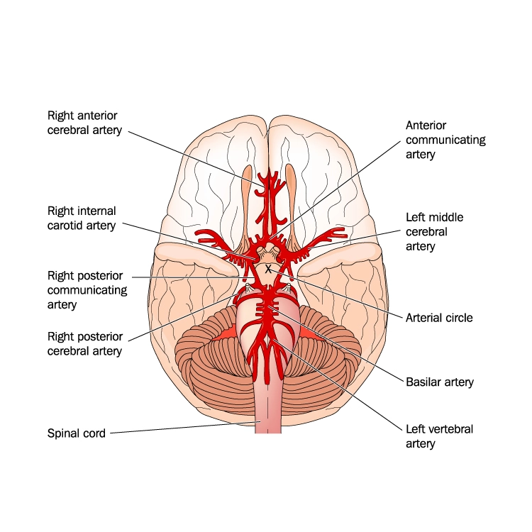 Digital Subtraction Angiography and CT Angiography