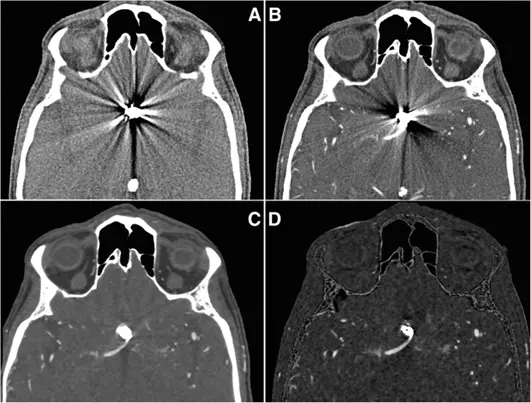 Digital Subtraction Angiography and CT Angiography