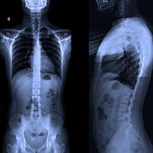 Radiographic Imaging of the Spine X-Ray