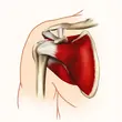 Ultrasound Assessment of the Rotator Cuff