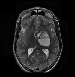 Coupe axiale TSE pondérée en T2 d’un cerveau