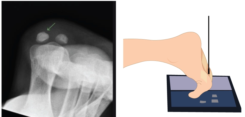 Sesamoid View: Lewis