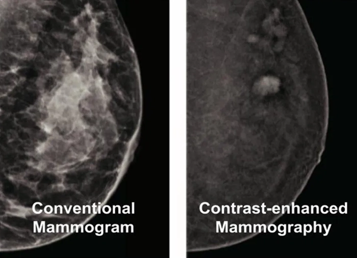 Advancements in Breast Imaging