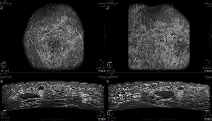 Advancements in Breast Imaging