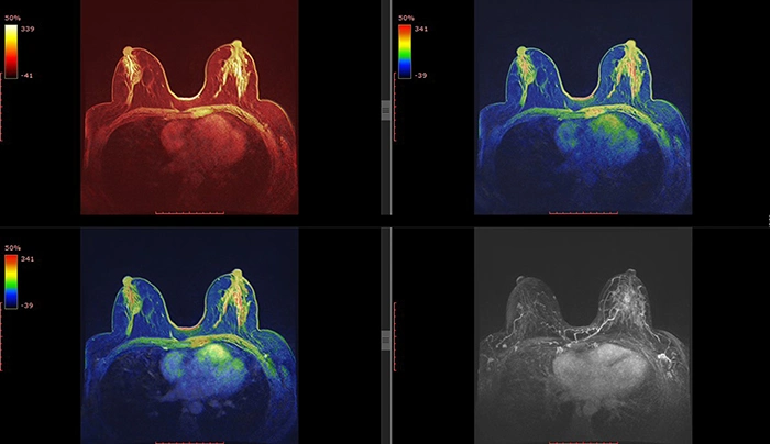 Advancements in Breast Imaging