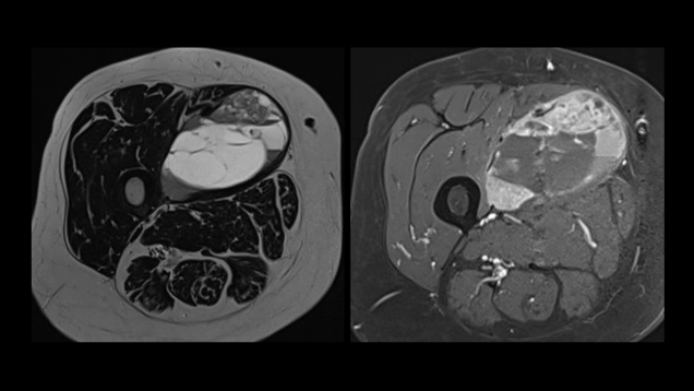 Imaging Adult Sarcomas CE Course