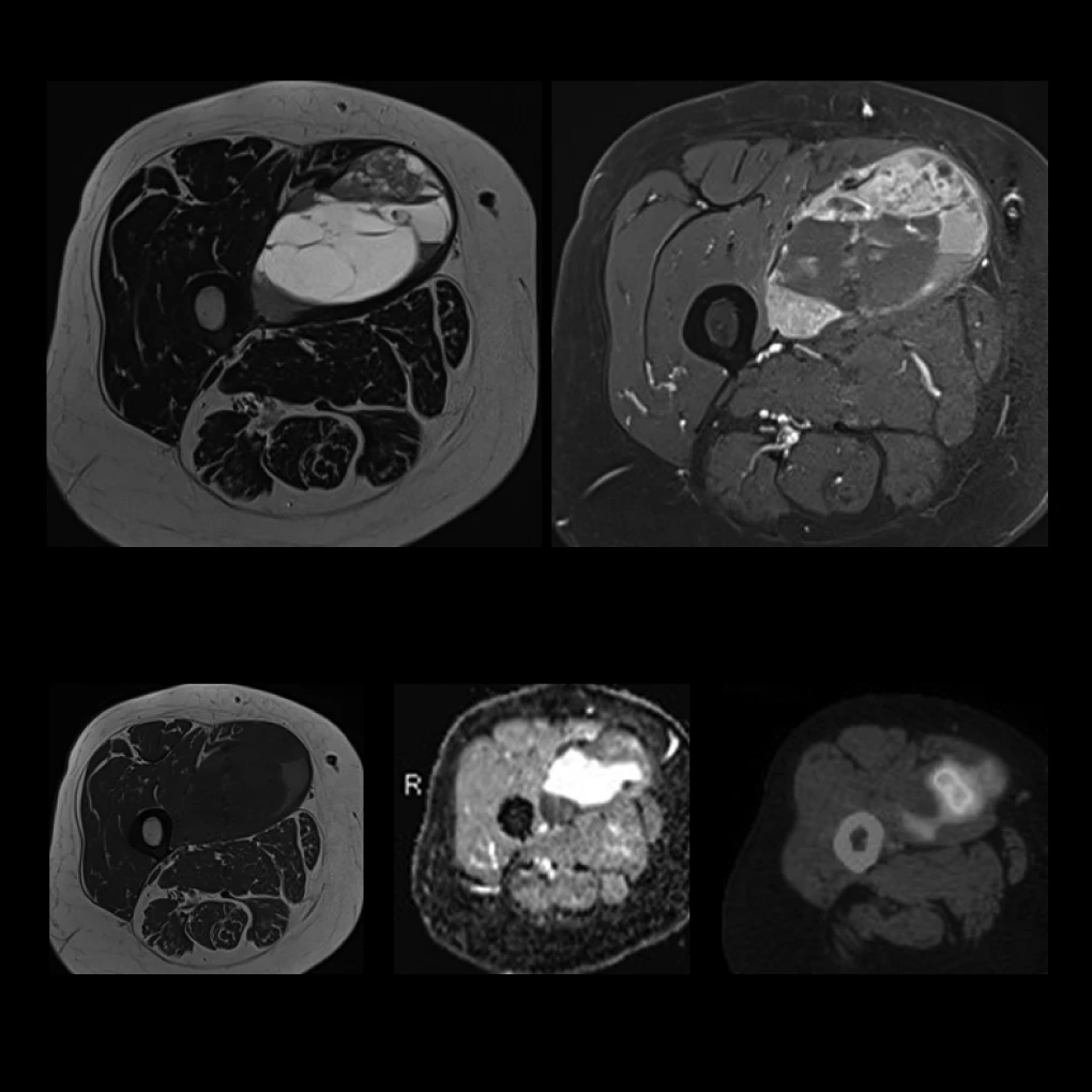 Imaging Adult Sarcomas