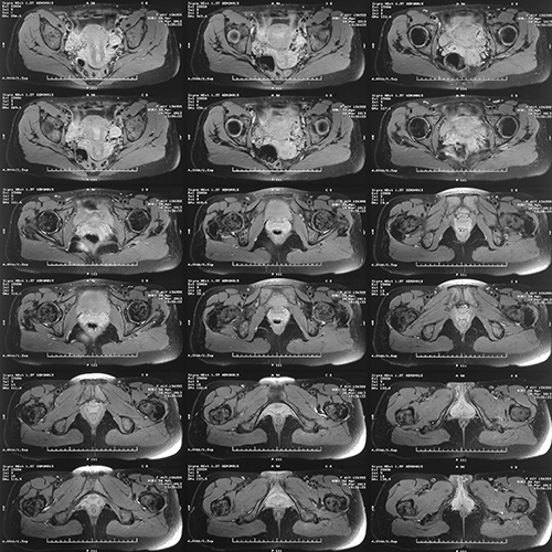 MRI of the Pelvis